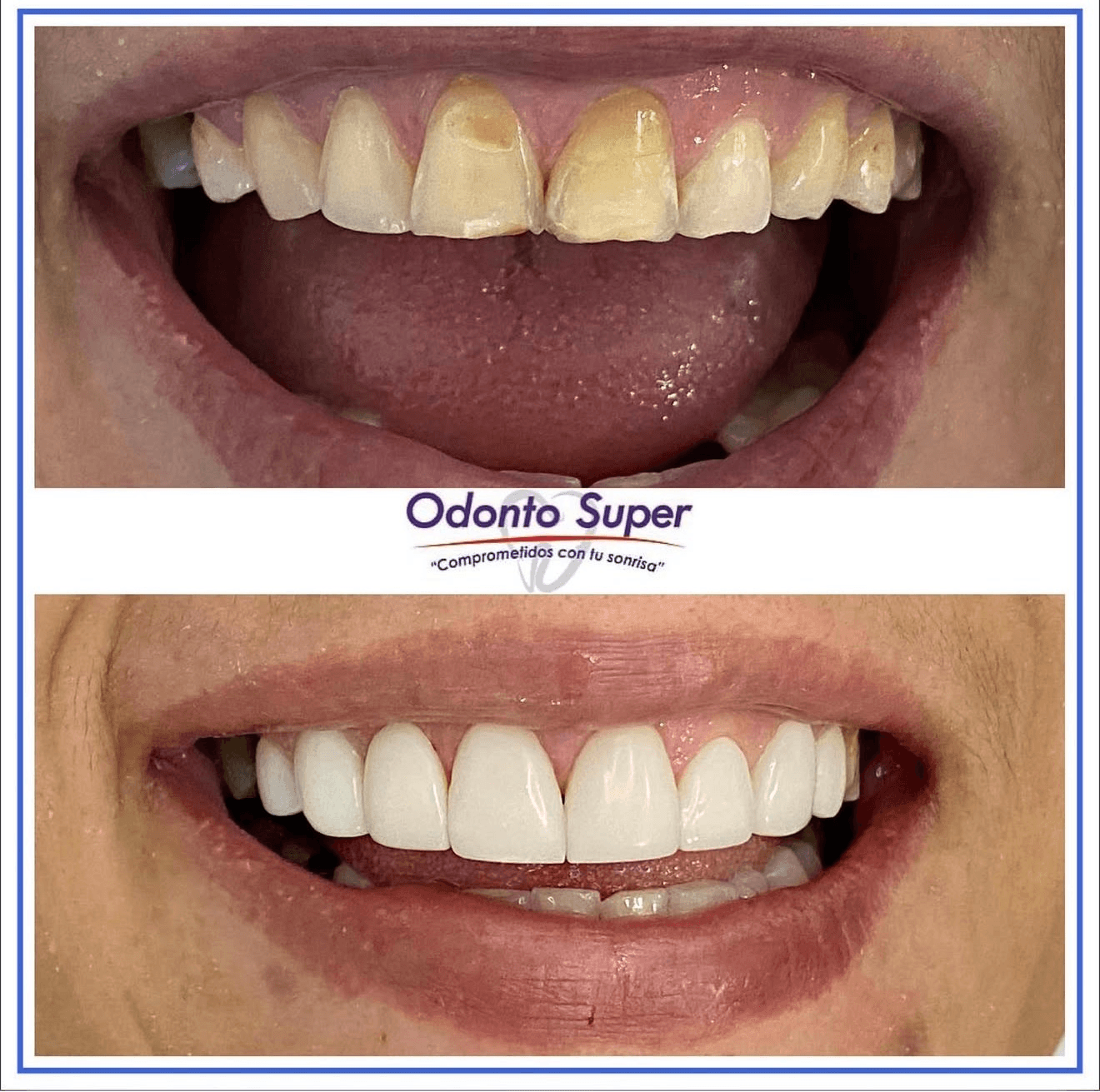 A real patient before and after full-arch treatment with a complete new smile