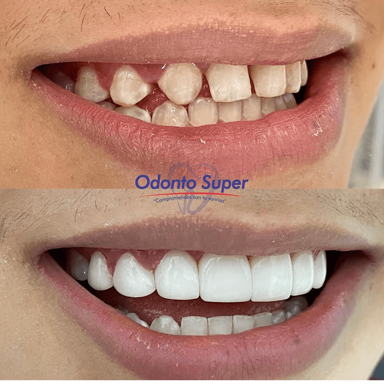 A real patient's smile before and after orthodontic treatment