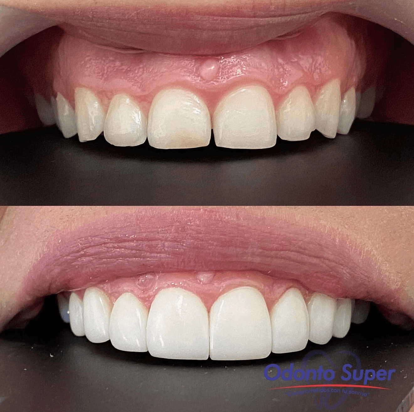 Before and after close-up of natural porcelain veneers on a real patient